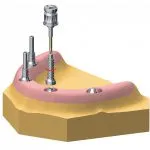 Digital illustration of the all-on-4 treatment concept inserting implants