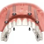 Digital illustration of the all-on-4 treatment concept attaching restorations
