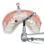 Digital illustration of the all-on-4 treatment concept