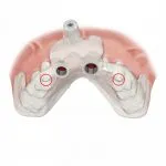 Digital illustration of the all-on-4 treatment concept