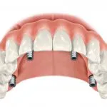 Digital illustration of the all-on-4 treatment concept