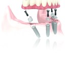 Digital illustration of the all-on-4 treatment concept