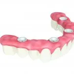 Digital illustration of the all-on-4 treatment concept