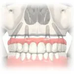Digital illustration of the all-on-4 treatment concept